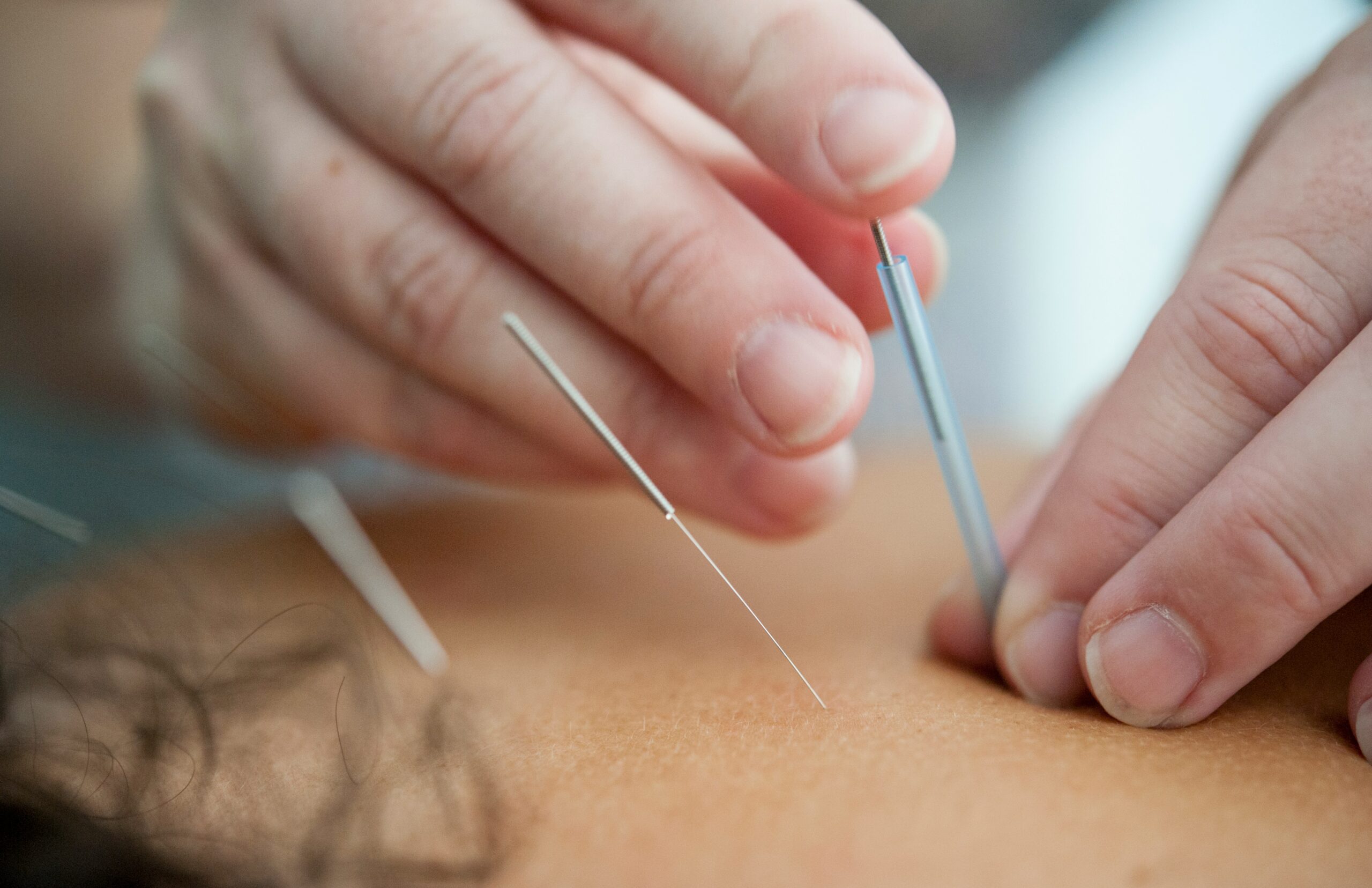 Acupuncture Diploma program at Ruhani College